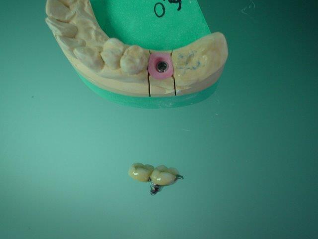 dentiste-bridge-belgique1 (1)