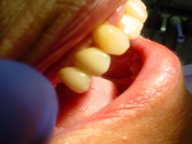 dentiste-bridges-belgique (4)