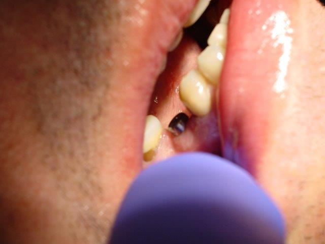 implants-dentiste-belgique (5)