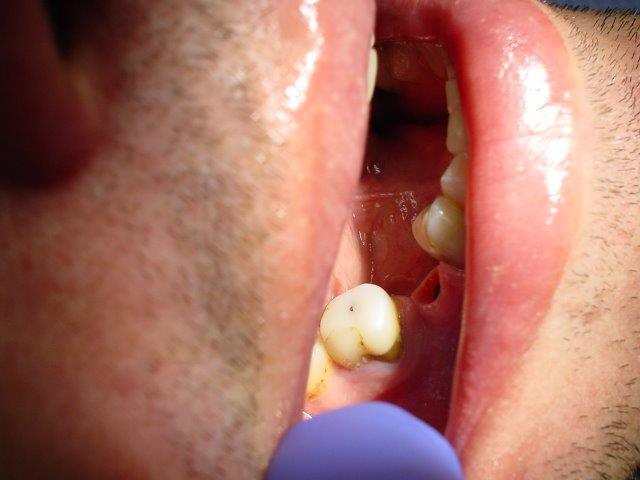 implants-dentiste-belgique (7)