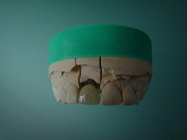 implants-dentiste-belgique1 (1)