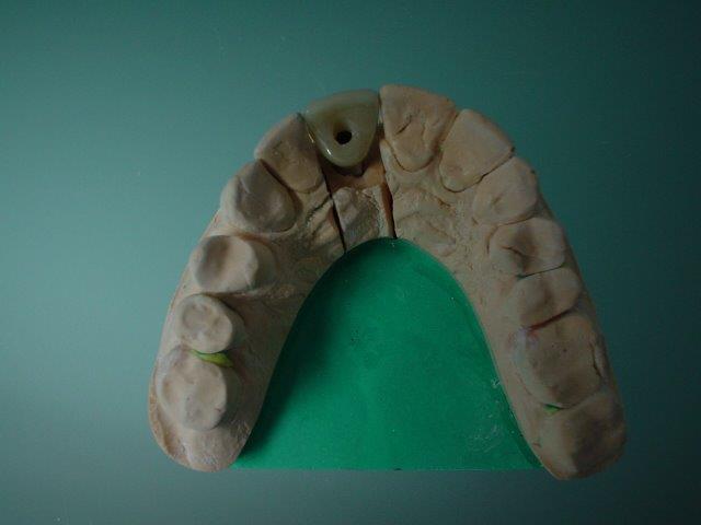 implants-dentiste-belgique1 (2)