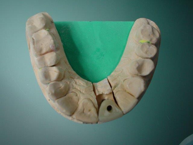 implants-dentiste-belgique1 (3)