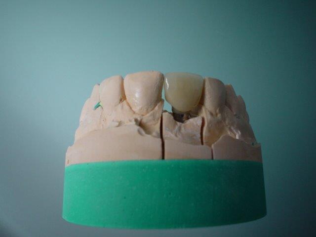 implants-dentiste-belgique1 (4)