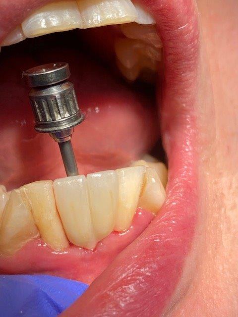 alternative de remplacement dentaire esth sur implants 1