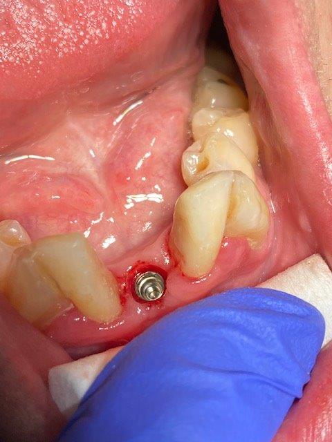 alternative de remplacement dentaire esth sur implants 8