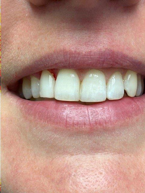 dentiste-hossay-bleaching (2)