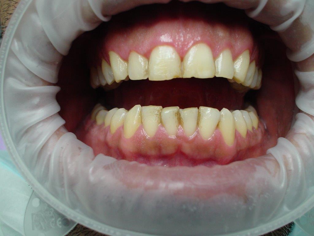 dentiste-hossay-detartrage (1)