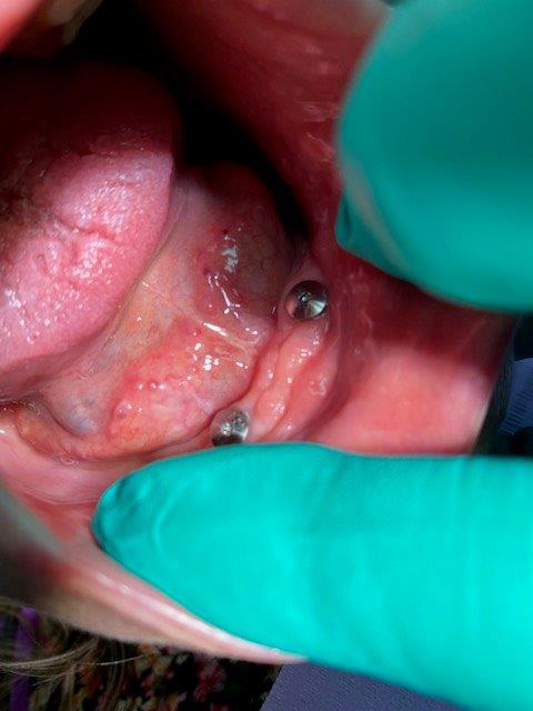 dentiste-hossay-prothese (2)
